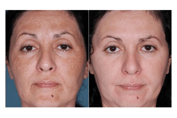 Natural Chemical Peel