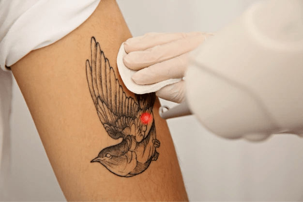 Laser Tattoo Removal