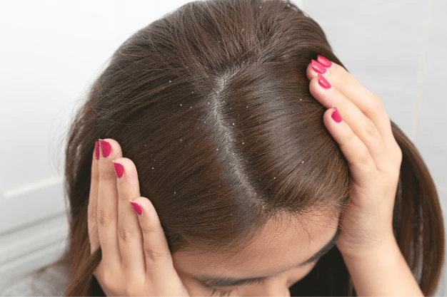 Dandruff (Pityriasis Simplex)