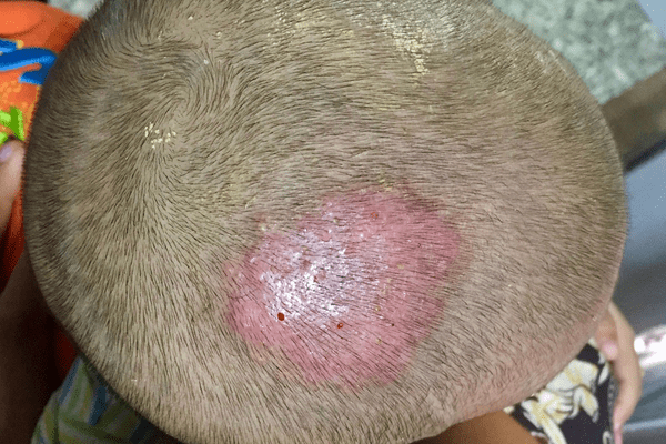 Ringworm (Tinea Capitis)