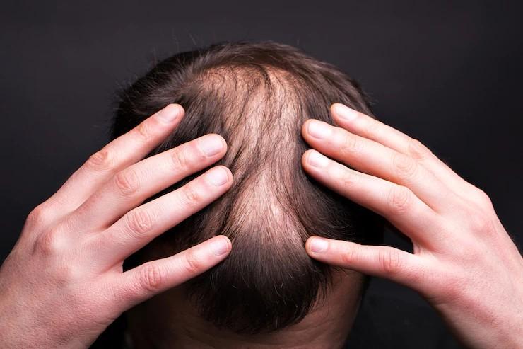 Diffuse Hair Loss