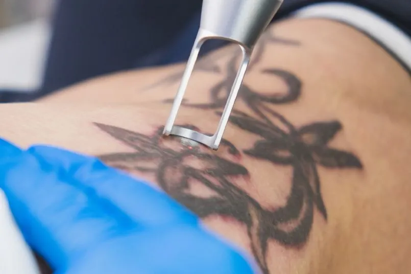 Laser-Tattoo-Removal-Treatment-in-Jabalpur